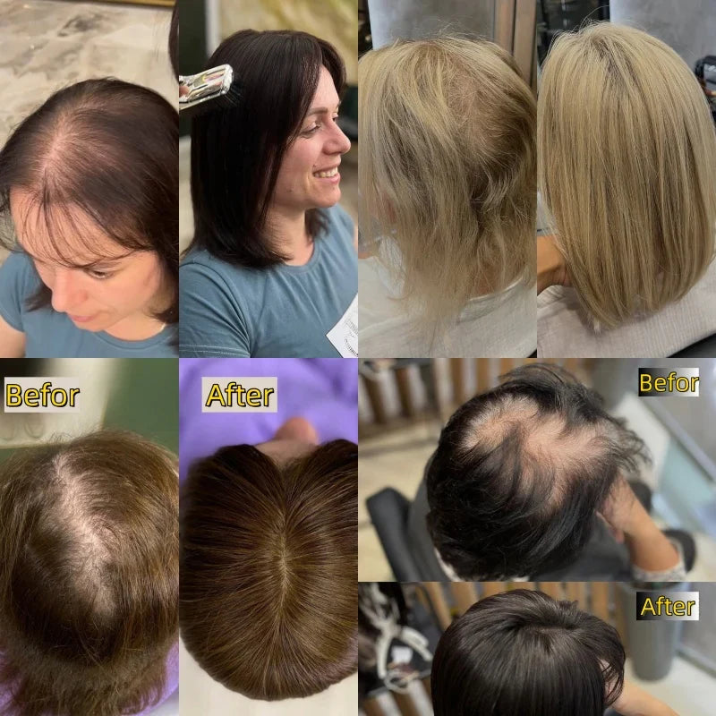Straight Hair Topper for Crown Thinning – Natural Coverage at the Crown