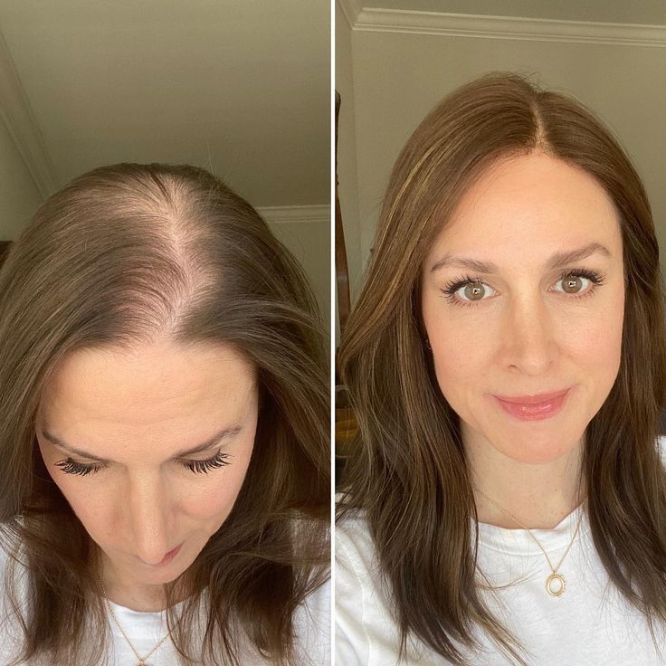 Hot Sale Full Hair Volume Crown Hair Topper For Women With Thinning Hair