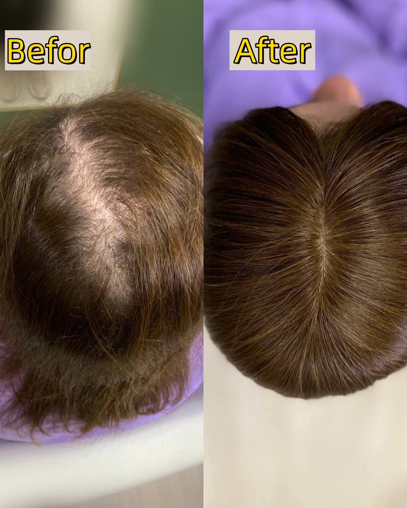 Straight Hair Topper for Crown Thinning – Natural Coverage at the Crown - VIVACROWN